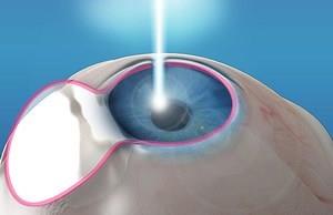 LASER Therapy Refractive Surgery